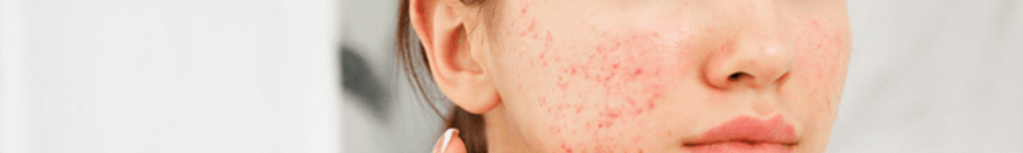 acne-da-mulher-adulta
